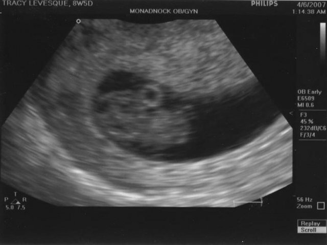 UltraSound 8-Weeks.JPG