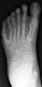 150px-Polydactyly_01_Lfoot_AP.jpg